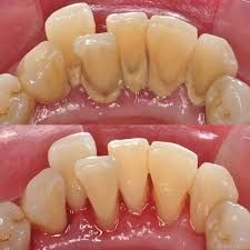 Zubi pre i posle uklanjanja kamenca - Parodontologija.jpg